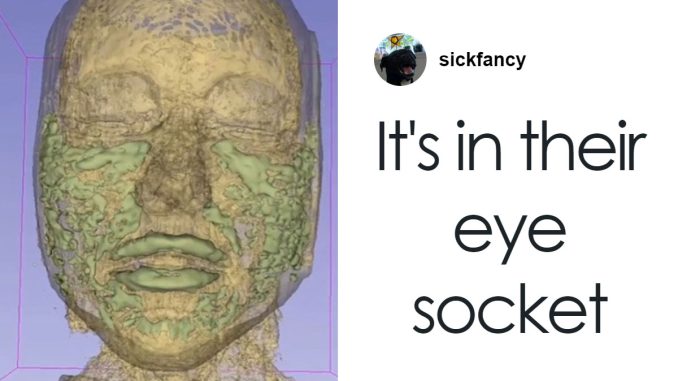MRI Of 33-Year-Old Woman’s Face Reveals Where All Her Filler Went