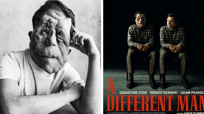“My Disability Has Opened Doors”: Actor Adam Pearson Wants To Normalize Facial Disfigurement