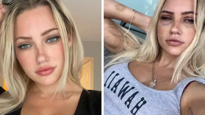 “Psycho” Plastic Surgeon Allegedly Used Ex As Slave, Forcibly Injected Fillers Without Anesthesia