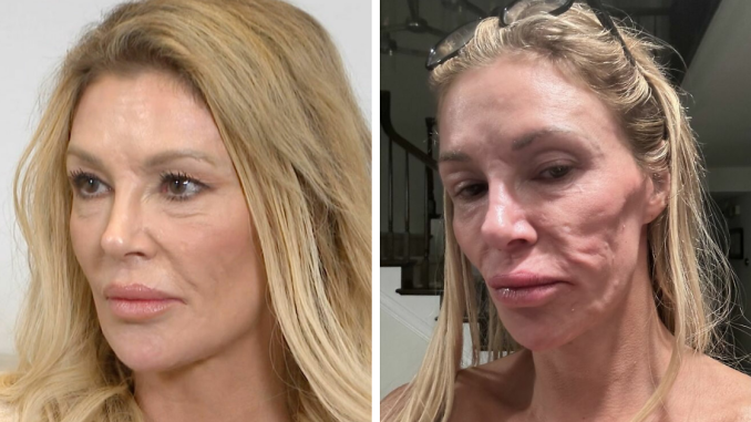 Brandi Glanville Says Her Face Has ‘Literally Melted Away’ Amid ‘Worse Than Ever’ Disfigurement