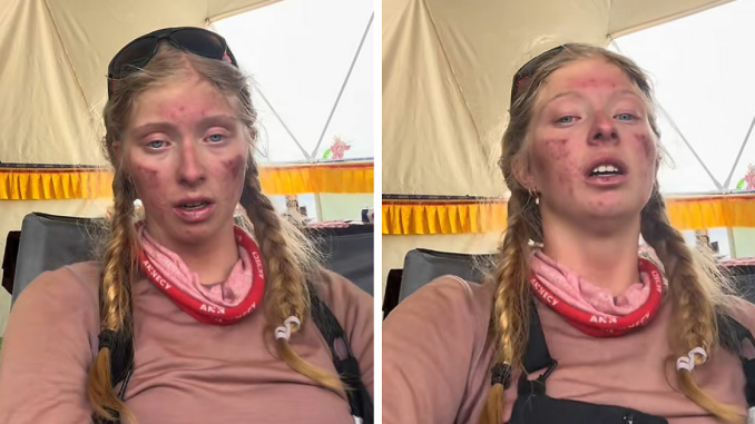 Severely Injured After Everest Climb, 17YO Teen Sparks Online Debate: “Why Take The Risk?”